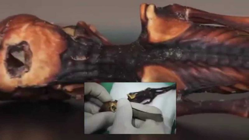 De Ata nem élhetett ilyen sokáig ennyire szokatlan deformációkkal.